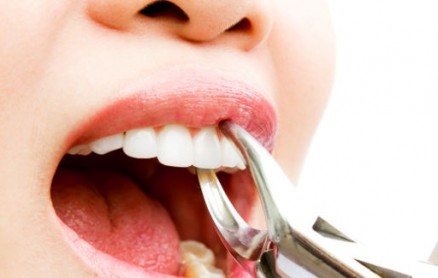 Chỉ định và chống chỉ định của nhổ răng