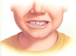 Răng trẻ bị mọc lệch