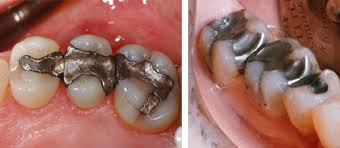 Sâu răng và cách điều trị
