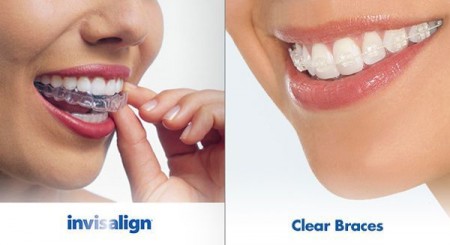 Giải pháp tốt nhất điều trị răng hô