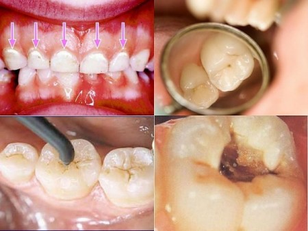 Nguyên nhân và điều trị sâu răng