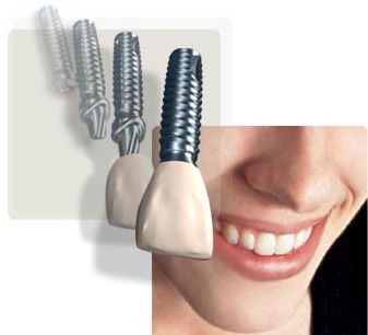 Cấy ghép Implant khi mất một răng cửa mất bao lâu