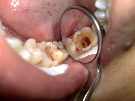 Có nên nhổ răng sâu hay không ?