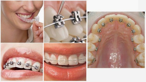 Giải pháp chỉnh hình cho hàm răng thưa