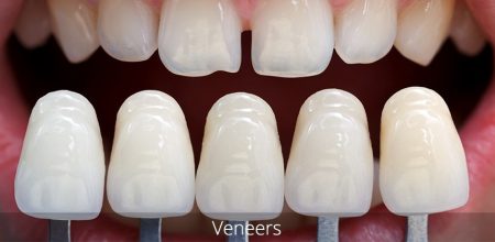 Sự khác biệt giữa răng sứ titan và răng sứ thường