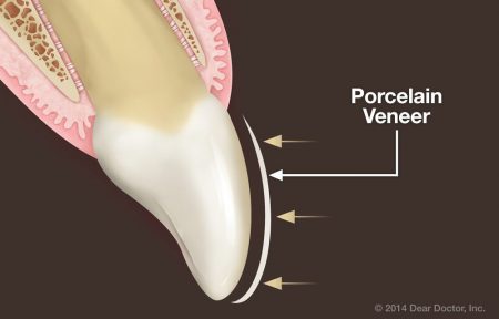 Bọc răng sứ veneer