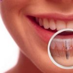 Cấy ghép implant  khi mất một răng
