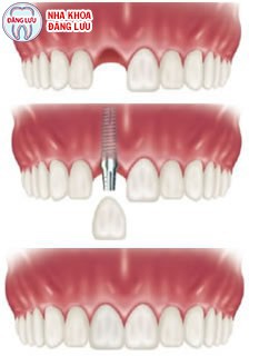 Cấy ghép implant khi mất một răng