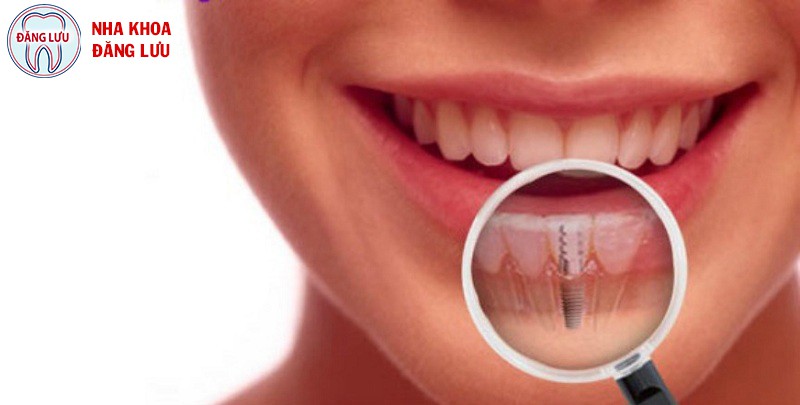 Cấy ghép implant  khi mất một răng