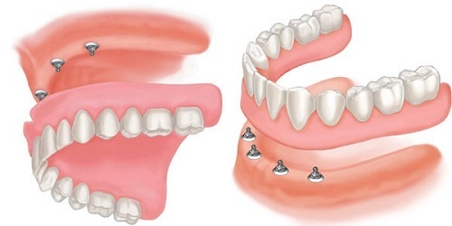 Cấy ghép implant  khi mất nhiều răng