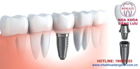 Chi phí cấy ghép implant là bao nhiêu