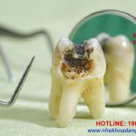 Điều trị sâu răng an toàn hiệu quả tại nha khoa
