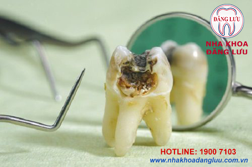 Điều trị sâu răng an toàn hiệu quả tại nha khoa