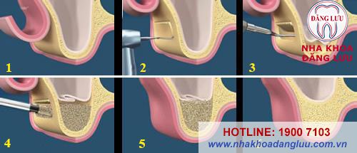 Nâng xoang ghép xương hàm khi cấy implant