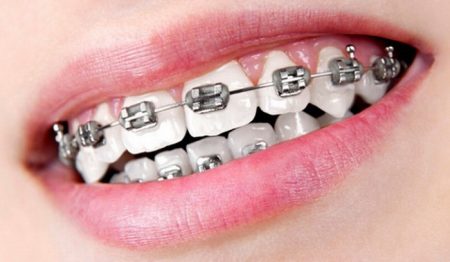 Phương pháp niềng răng nhanh hiệu quả