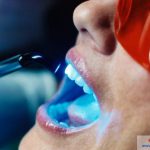 Tẩy trắng răng laser tại nha khoa