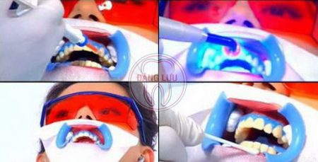 Tẩy trắng răng laser tại nha khoa