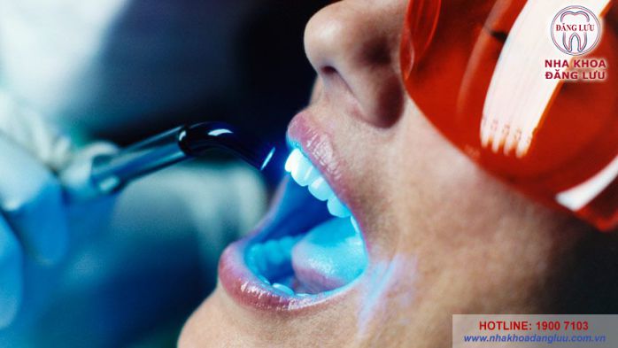 Tẩy trắng răng laser tại nha khoa