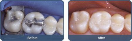 Trám răng thẩm mỹ