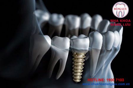 Trồng răng thẩm mỹ