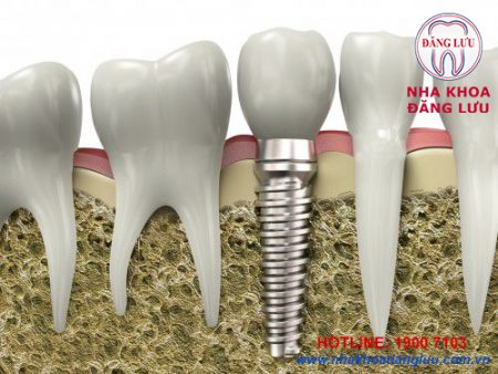 Cấy ghép implant cho răng hàm