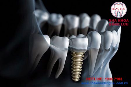 Cấy ghép implant cho răng hàm