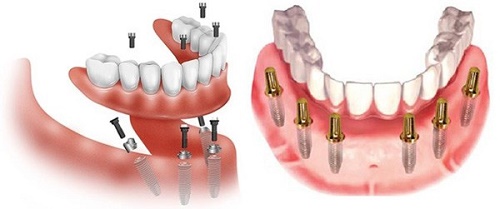 Cấy ghép răng implant ở đâu tốt hiện nay? 1