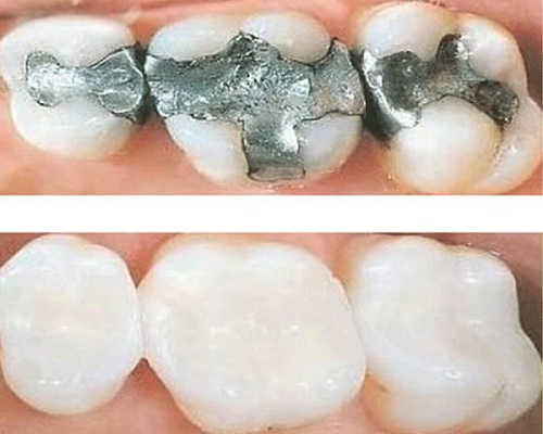 Kĩ thuật trám răng 2