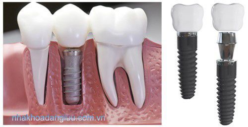 Những lưu ý khi cấy răng với implant 1