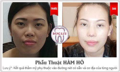 Phẫu thuật hàm hô có nguy hiểm không