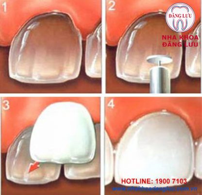 Dán răng sứ veneer dùng những lớp sứ mỏng (0.3 – 0.6 mm) để dán lên vùng răng cần điều trị của hàm (giống như những chiếc móng giả) Răng sứ veneer giúp bảo vệ những răng thật đồng thời hạn chế sự mài mòn răng khi lắp đặt. Đây là điểm khác biệt cải tiến của dán răng sứ veneer với các phương pháp chỉnh nha trước đó. 
