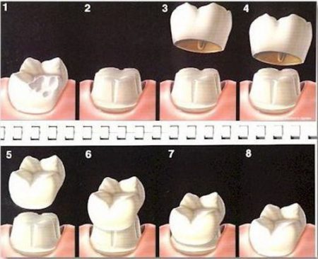 Răng sứ zirconia