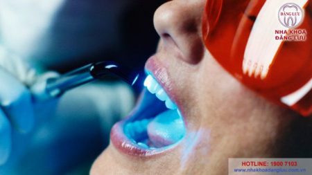 Tẩy trắng răng tự nhiên với laser whitening