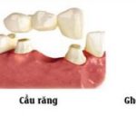 Trồng răng hàm có đau không