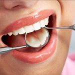 độ bền của răng sứ thẩm mỹ