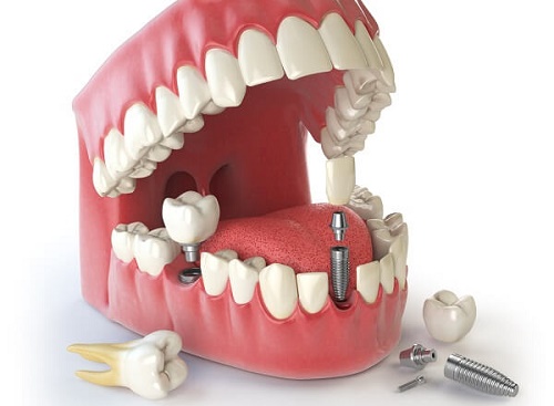 Cấy ghép implant thay thế nhiều răng 2