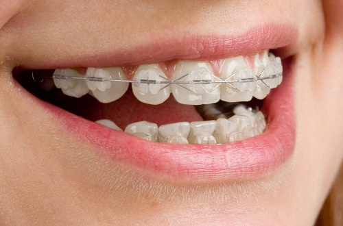 Chi phí trồng răng hàm hết bao nhiêu? 1