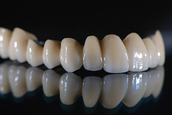 nên bọc răng sứ hay cấy ghép implant