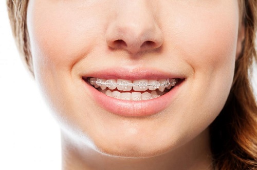 Niềng răng mặt trong mức giá bao nhiêu? 3