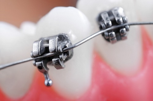 Niềng răng với mắc cài kim loại 3