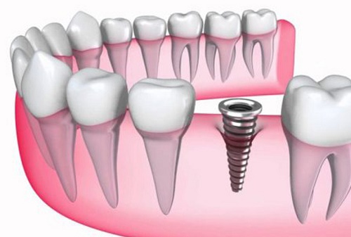 Phương pháp trồng răng implant hiệu quả 2