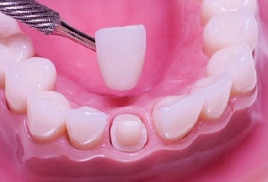 hời gian bọc răng sứ có lâu không