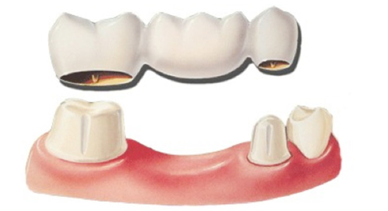 rồng răng giả cố định giá bao nhiêu