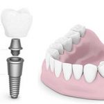 trồng răng implant có đau khôn
