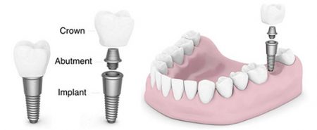 trồng răng implant có đau khôn