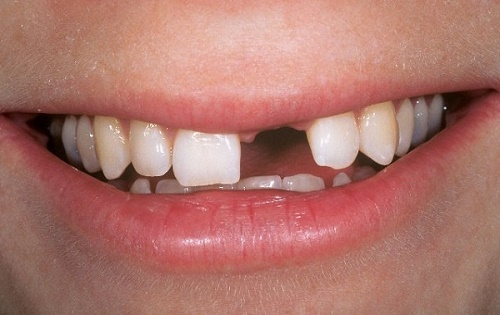 Trồng răng Implant giá cao không? 1
