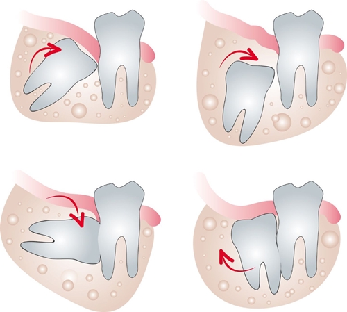 đau răng khôn nguyên nhân và cách xử lý