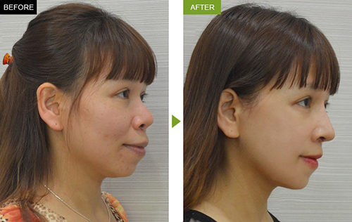 chăm sóc sau phẫu thuật hàm hô đúng cách (