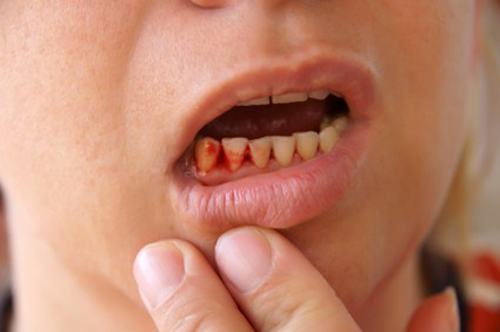 chảy máu răng thường xuyên 