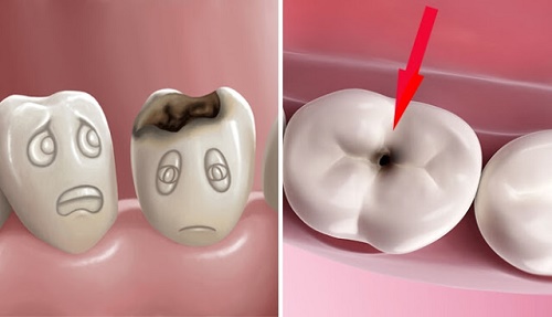 Có nên nhổ răng bị sâu không? 2